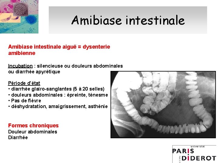 Amibiase intestinale aiguë = dysenterie amibienne Incubation : silencieuse ou douleurs abdominales ou diarrhée