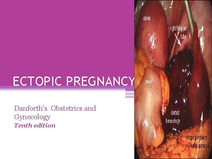 ECTOPIC PREGNANCY Danforth’s Obstetrics and Gynecology Tenth edition 