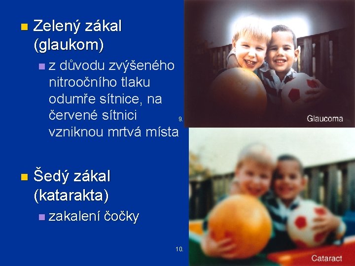 n Zelený zákal (glaukom) n n z důvodu zvýšeného nitroočního tlaku odumře sítnice, na
