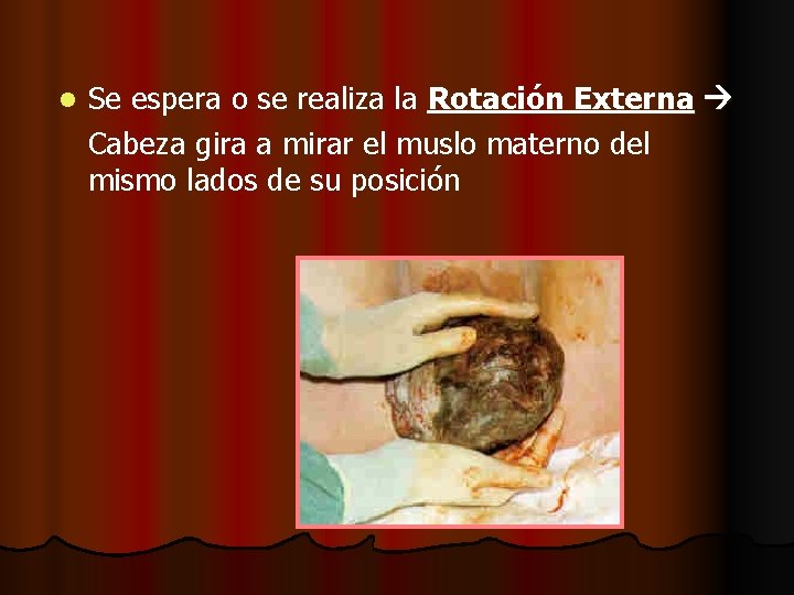 l Se espera o se realiza la Rotación Externa Cabeza gira a mirar el