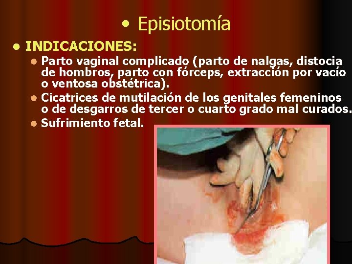  • Episiotomía l INDICACIONES: Parto vaginal complicado (parto de nalgas, distocia de hombros,