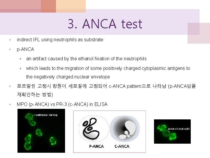 3. ANCA test • indirect IFL using neutrophils as substrate • p-ANCA • an