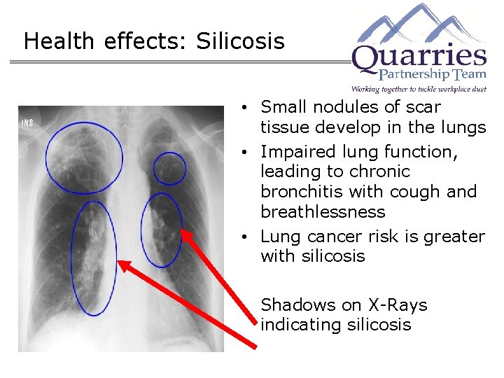 Health effects: Silicosis • Small nodules of scar tissue develop in the lungs •