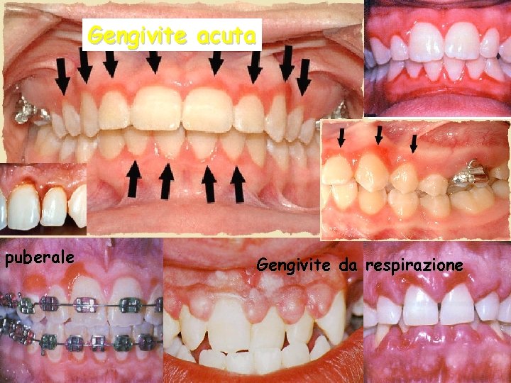 Gengivite acuta puberale Gengivite da respirazione 