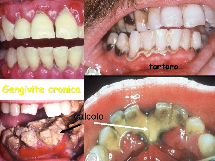 tartaro Gengivite cronica calcolo 