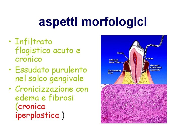aspetti morfologici • Infiltrato flogistico acuto e cronico • Essudato purulento nel solco gengivale