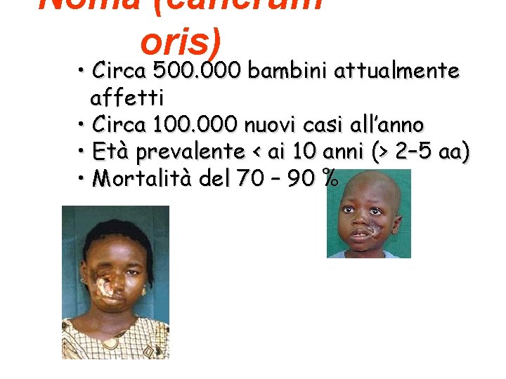 Noma (cancrum oris) • Circa 500. 000 bambini attualmente affetti • Circa 100. 000