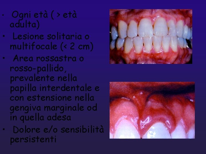  • Ogni età ( > età adulta) • Lesione solitaria o multifocale (<