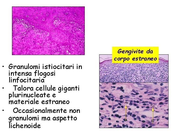  • Granulomi istiocitari in intensa flogosi linfocitaria • Talora cellule giganti plurinucleate e