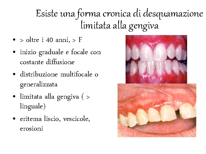 Esiste una forma cronica di desquamazione limitata alla gengiva • > oltre i 40