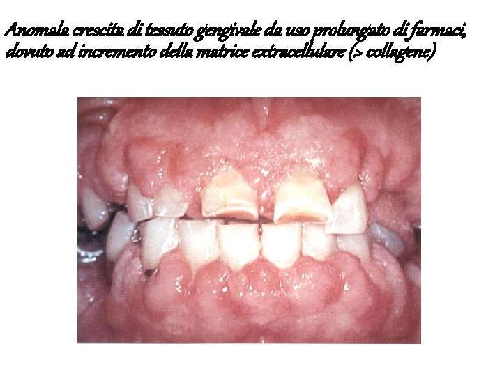Anomala crescita di tessuto gengivale da uso prolungato di farmaci, dovuto ad incremento della