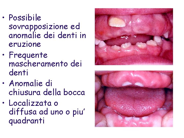  • Possibile sovrapposizione ed anomalie dei denti in eruzione • Frequente mascheramento dei
