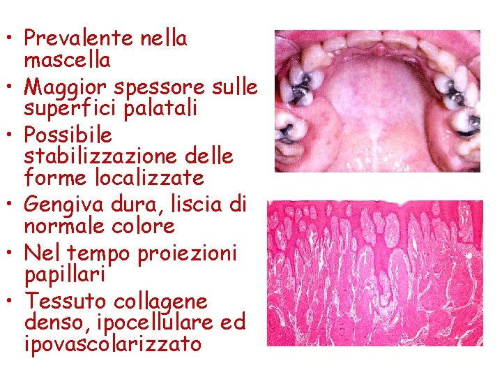  • Prevalente nella mascella • Maggior spessore sulle superfici palatali • Possibile stabilizzazione