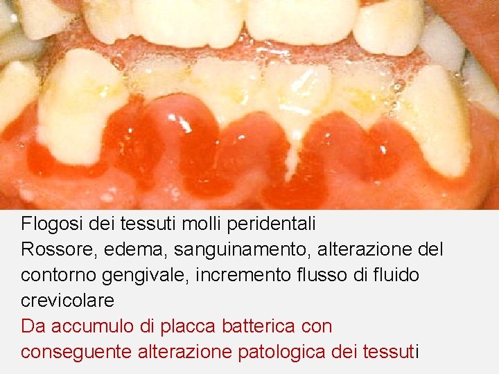 Flogosi dei tessuti molli peridentali Rossore, edema, sanguinamento, alterazione del contorno gengivale, incremento flusso