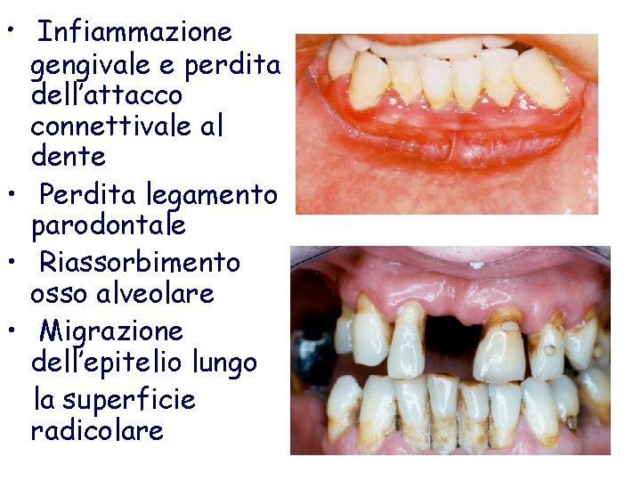 Infiammazione gengivale e perdita dell’attacco connettivale al dente • Perdita legamento parodontale • Riassorbimento