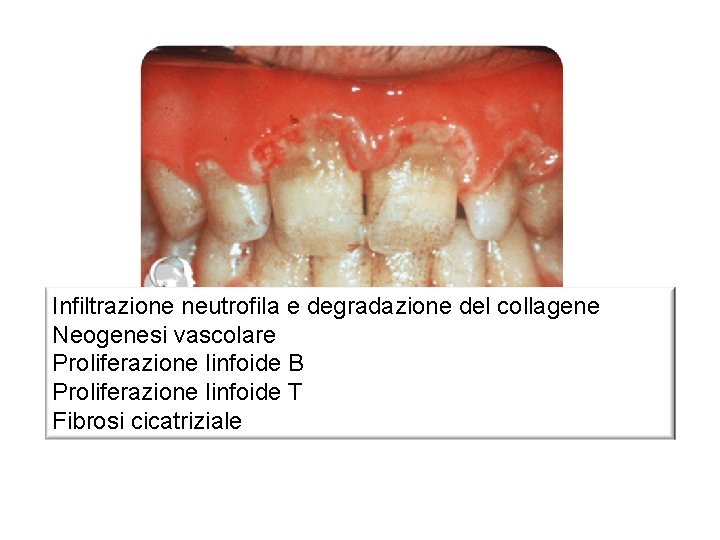 Infiltrazione neutrofila e degradazione del collagene Neogenesi vascolare Proliferazione linfoide B Proliferazione linfoide T