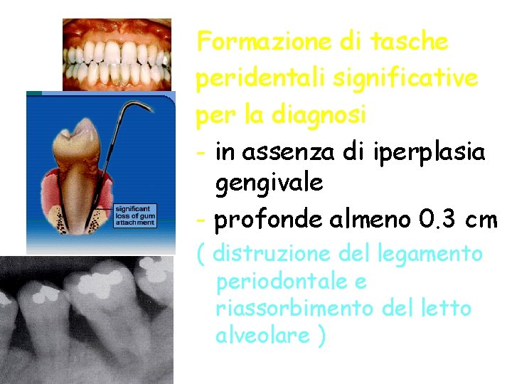 Formazione di tasche peridentali significative per la diagnosi - in assenza di iperplasia gengivale