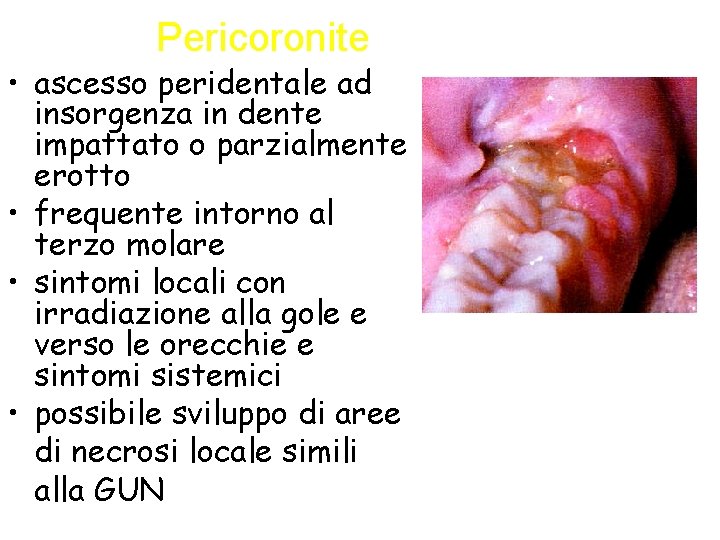 Pericoronite • ascesso peridentale ad insorgenza in dente impattato o parzialmente erotto • frequente