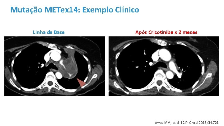 Mutação METex 14: Exemplo Clínico Linha de Base Após Crizotinibe x 2 meses Awad