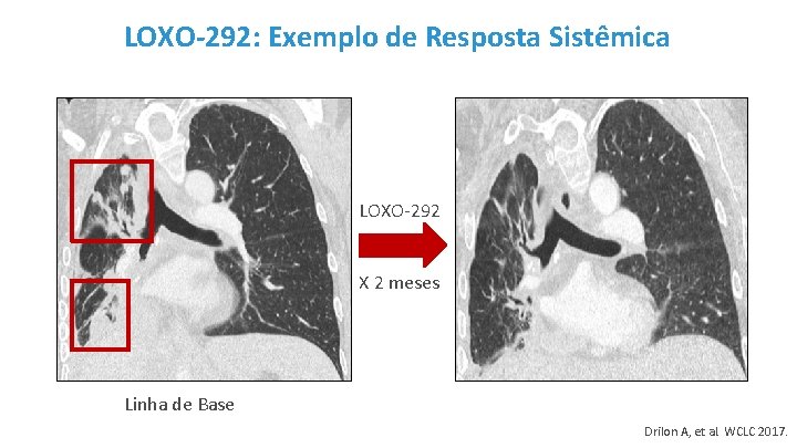 LOXO-292: Exemplo de Resposta Sistêmica LOXO-292 X 2 meses Linha de Base Drilon A,