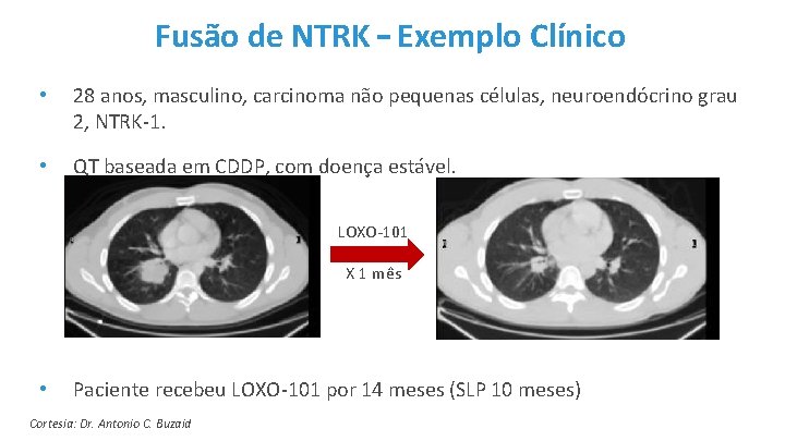 Fusão de NTRK – Exemplo Clínico • 28 anos, masculino, carcinoma não pequenas células,