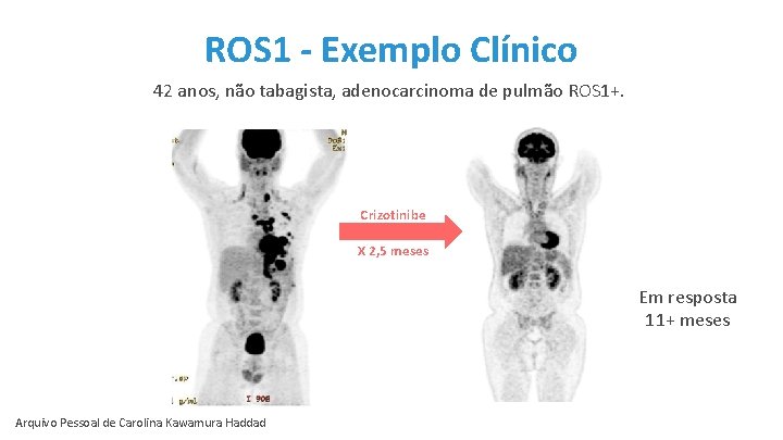 ROS 1 - Exemplo Clínico 42 anos, não tabagista, adenocarcinoma de pulmão ROS 1+.
