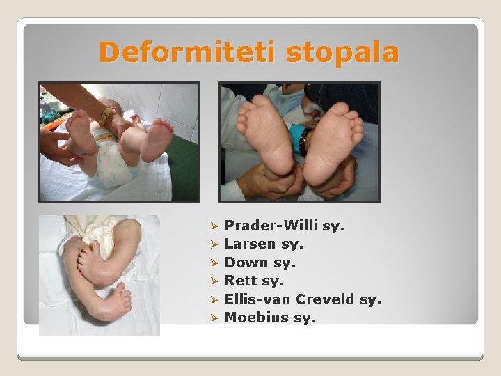 Deformiteti stopala Ø Ø Ø Prader-Willi sy. Larsen sy. Down sy. Rett sy. Ellis-van Deformiteti stopala Ø Ø Ø Prader-Willi sy. Larsen sy. Down sy. Rett sy. Ellis-van