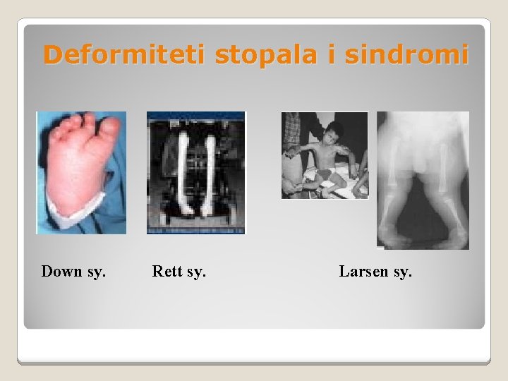 Deformiteti stopala i sindromi Down sy. Rett sy. Larsen sy. 