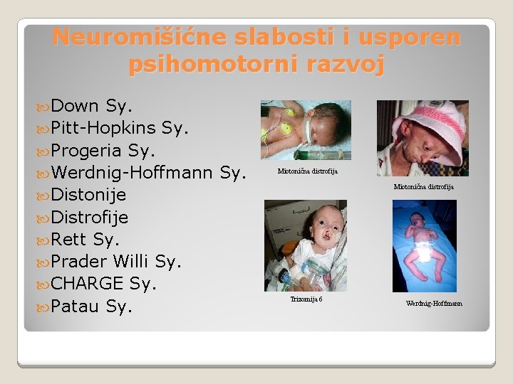 Neuromišićne slabosti i usporen psihomotorni razvoj Down Sy. Pitt-Hopkins Sy. Progeria Sy. Werdnig-Hoffmann Sy.