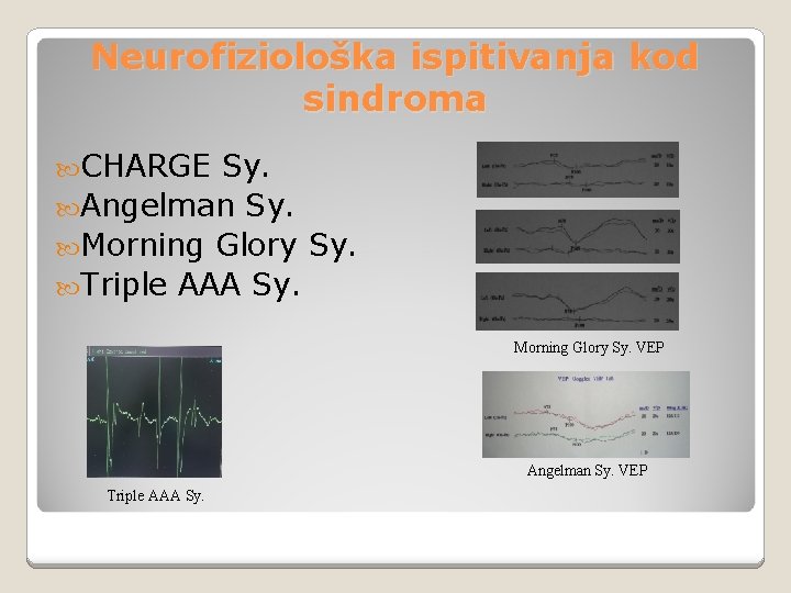 Neurofiziološka ispitivanja kod sindroma CHARGE Sy. Angelman Sy. Morning Glory Sy. Triple AAA Sy.