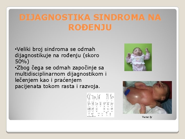 DIJAGNOSTIKA SINDROMA NA ROĐENJU • Veliki broj sindroma se odmah dijagnostikuje na rođenju (skoro DIJAGNOSTIKA SINDROMA NA ROĐENJU • Veliki broj sindroma se odmah dijagnostikuje na rođenju (skoro