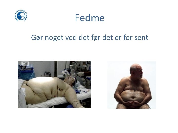 Fedme Gør noget ved det før det er for sent 