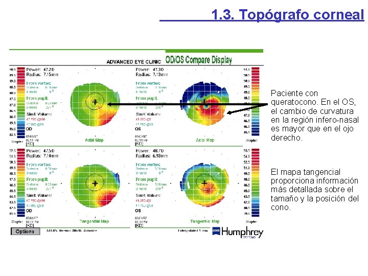1. 3. Topógrafo corneal Paciente con queratocono. En el OS, el cambio de curvatura 1. 3. Topógrafo corneal Paciente con queratocono. En el OS, el cambio de curvatura