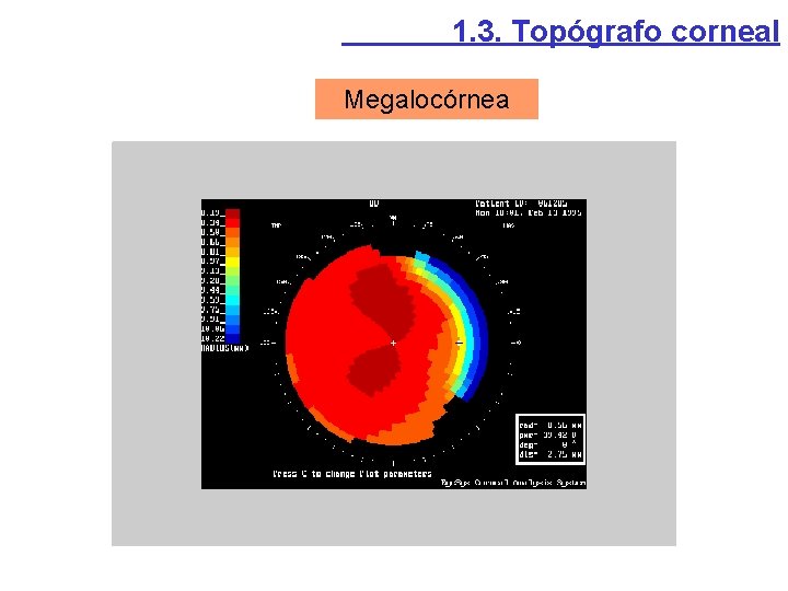 1. 3. Topógrafo corneal Megalocórnea 1. 3. Topógrafo corneal Megalocórnea