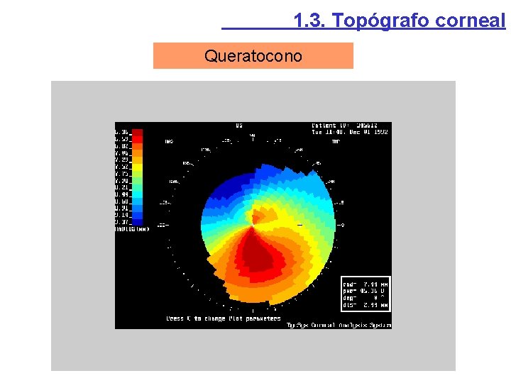 1. 3. Topógrafo corneal Queratocono 1. 3. Topógrafo corneal Queratocono
