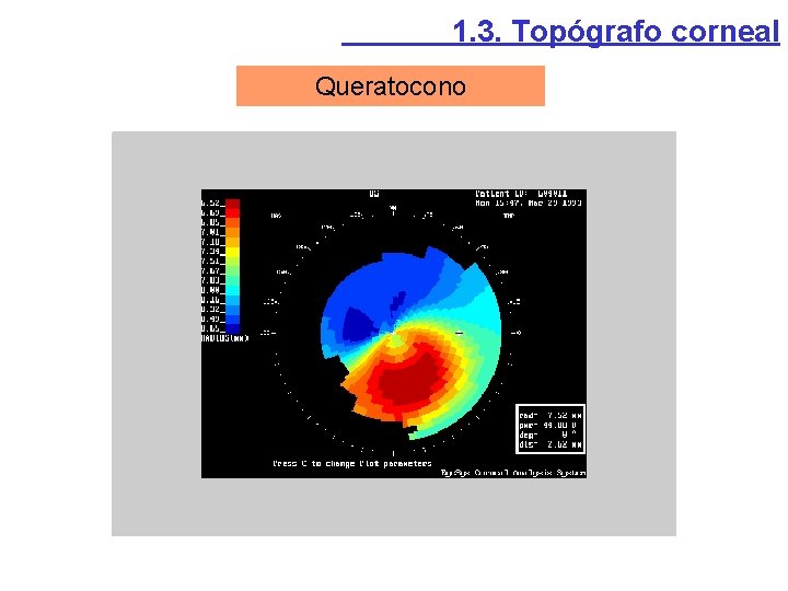 1. 3. Topógrafo corneal Queratocono 1. 3. Topógrafo corneal Queratocono
