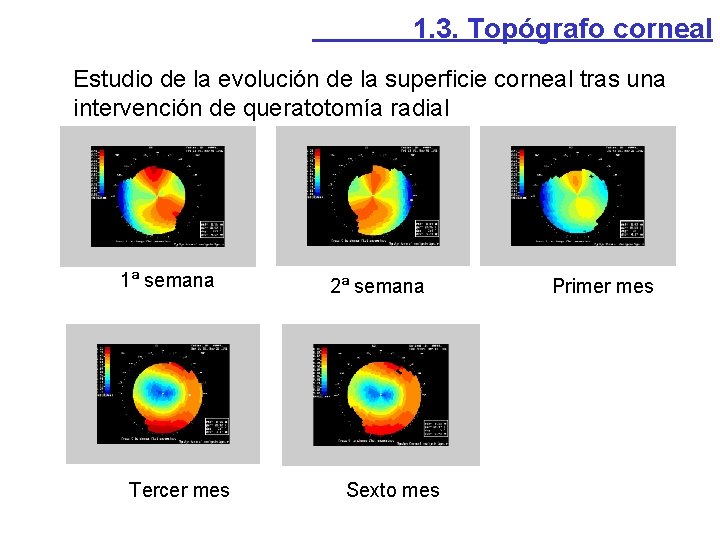 1. 3. Topógrafo corneal Estudio de la evolución de la superficie corneal tras una 1. 3. Topógrafo corneal Estudio de la evolución de la superficie corneal tras una