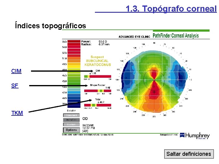 1. 3. Topógrafo corneal Índices topográficos CIM SF TKM Saltar definiciones 1. 3. Topógrafo corneal Índices topográficos CIM SF TKM Saltar definiciones