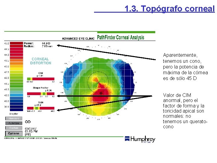 1. 3. Topógrafo corneal Aparentemente, tenemos un cono, pero la potencia de máxima de 1. 3. Topógrafo corneal Aparentemente, tenemos un cono, pero la potencia de máxima de