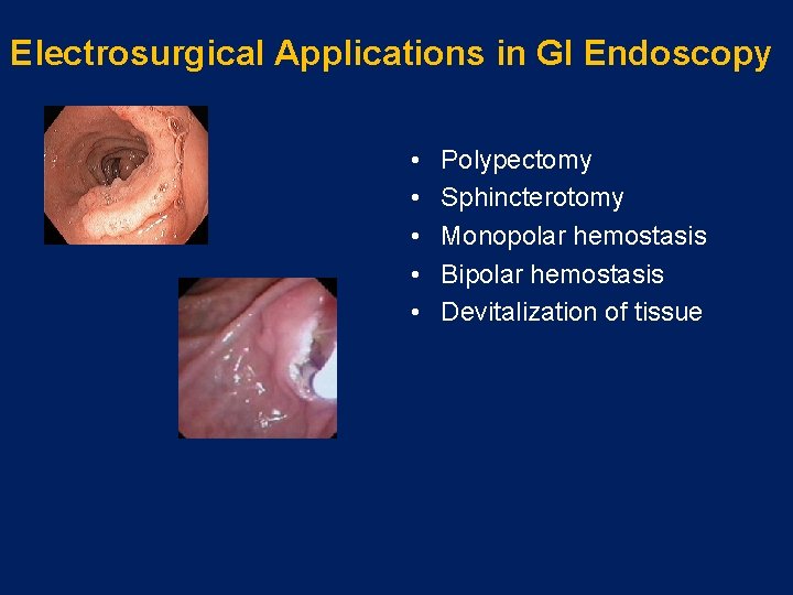 Electrosurgical Applications in GI Endoscopy • • • Polypectomy Sphincterotomy Monopolar hemostasis Bipolar hemostasis