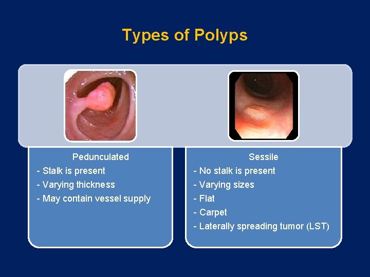 Types of Polyps Pedunculated - Stalk is present - Varying thickness - May contain