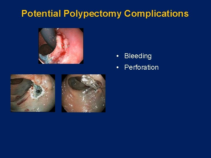 Potential Polypectomy Complications • Bleeding • Perforation 