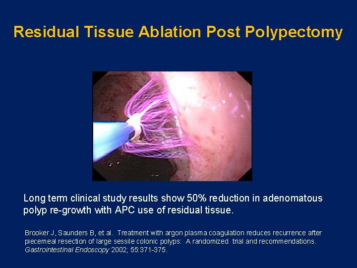 Residual Tissue Ablation Post Polypectomy Long term clinical study results show 50% reduction in