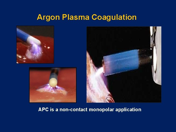 Argon Plasma Coagulation APC is a non-contact monopolar application 