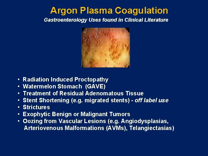 Argon Plasma Coagulation Gastroenterology Uses found in Clinical Literature • Radiation Induced Proctopathy •