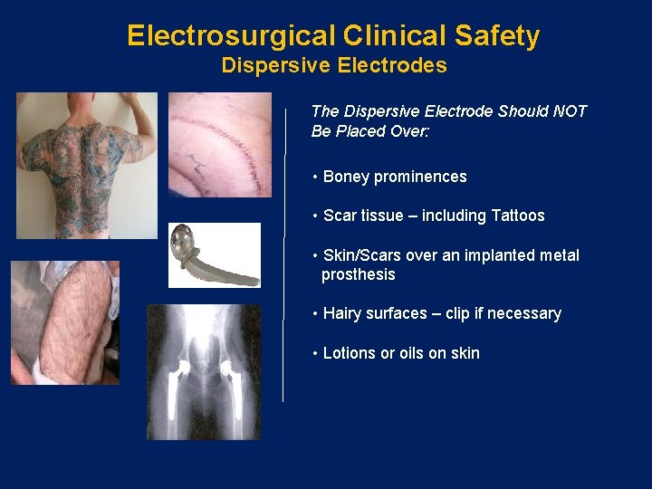 Electrosurgical Clinical Safety Dispersive Electrodes The Dispersive Electrode Should NOT Be Placed Over: •