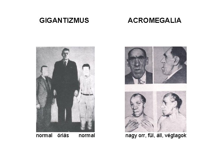 GIGANTIZMUS normal óriás normal ACROMEGALIA nagy orr, fül, áll, végtagok 