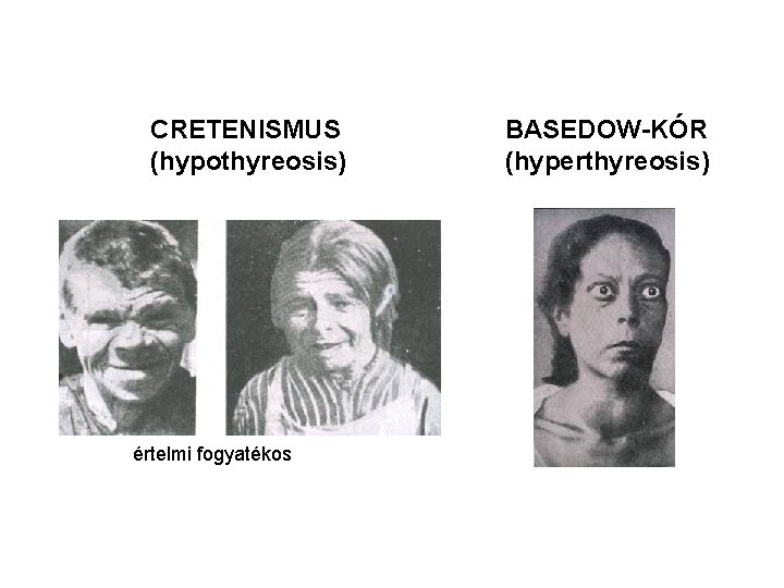 CRETENISMUS (hypothyreosis) értelmi fogyatékos BASEDOW-KÓR (hyperthyreosis) 