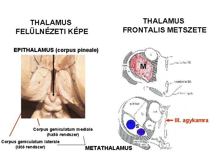 THALAMUS FELÜLNÉZETI KÉPE THALAMUS FRONTALIS METSZETE EPITHALAMUS (corpus pineale) M vpl Corpus geniculatum mediale