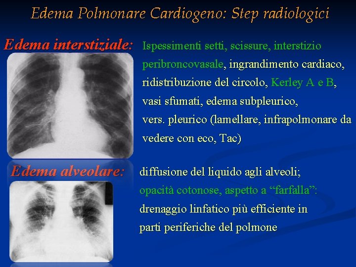 Edema Polmonare Cardiogeno: Step radiologici Edema interstiziale: Ispessimenti setti, scissure, interstizio peribroncovasale, ingrandimento cardiaco,